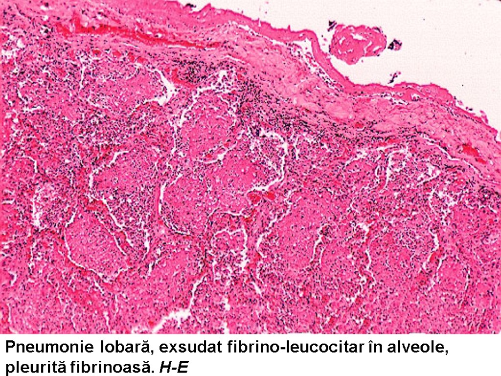 Pneumonie lobară, exsudat fibrino-leucocitar în alveole, pleurită fibrinoasă. H-E